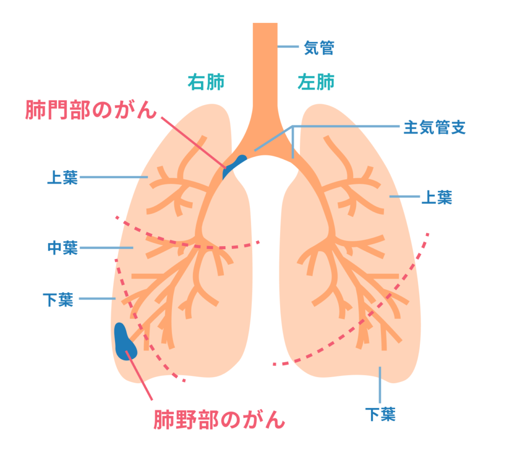 肺がん 症状 初期