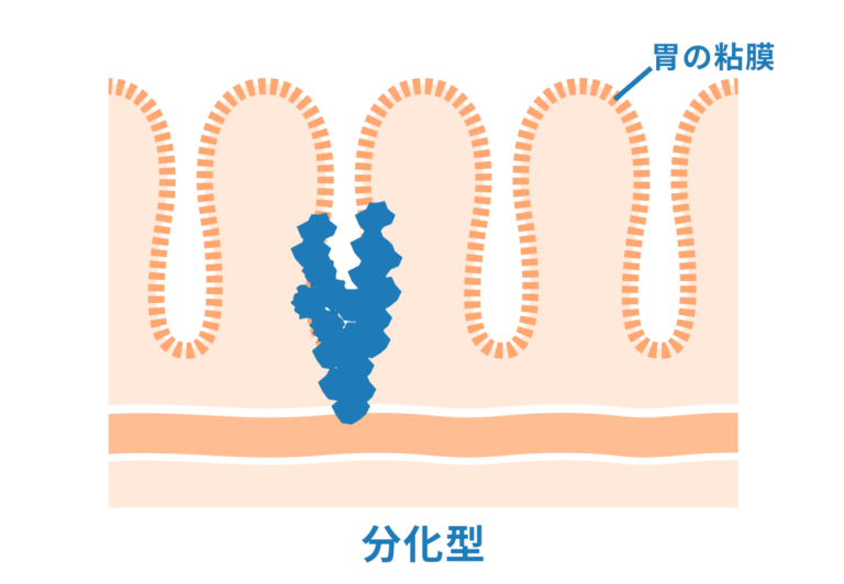 胃がん検査は何歳から?胃がんの症状・検査方法・頻度・費用を解説