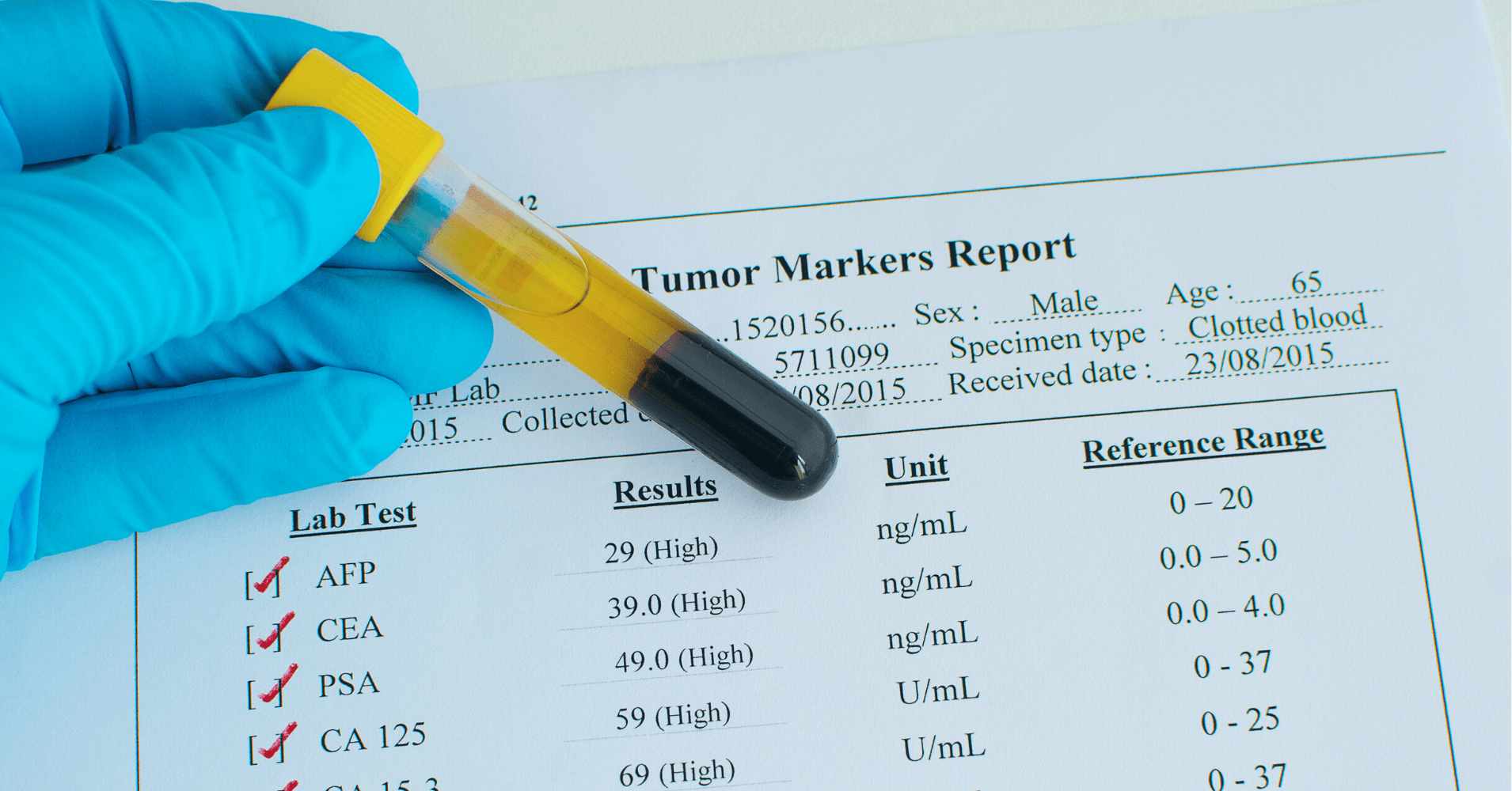腫瘍マーカー検査とは、がんの早期発見には不向き？基準値も解説